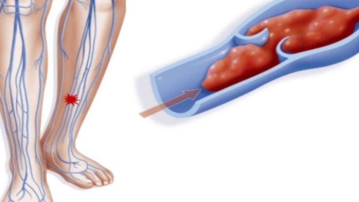 Trombóza je tichý, hlavne nenápadný a zákerný zabijak. Skutočné príznaky trombózy by mal vedieť rozoznať každý
