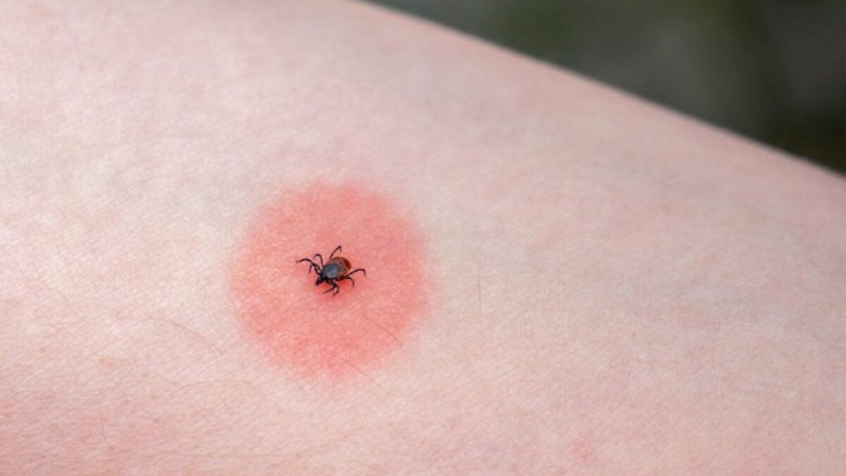 Choroby prenášané kliešťom: Ako ich spoznáte?