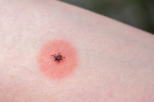 Choroby prenášané kliešťom: Ako ich spoznáte?