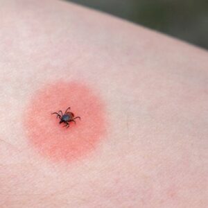 Choroby prenášané kliešťom: Ako ich spoznáte?