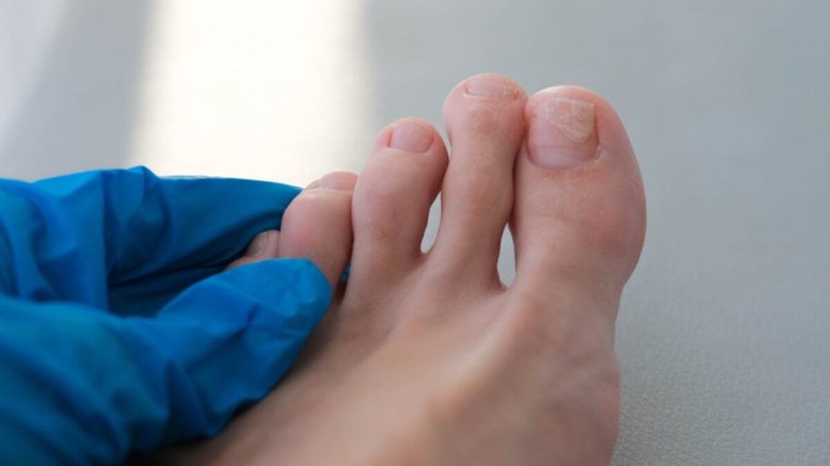 Plieseň na nechte: Konkrétne rady od lekárničky, ako sa jej zbaviť