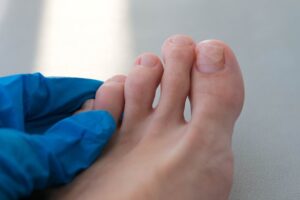 Plieseň na nechte: Konkrétne rady od lekárničky, ako sa jej zbaviť