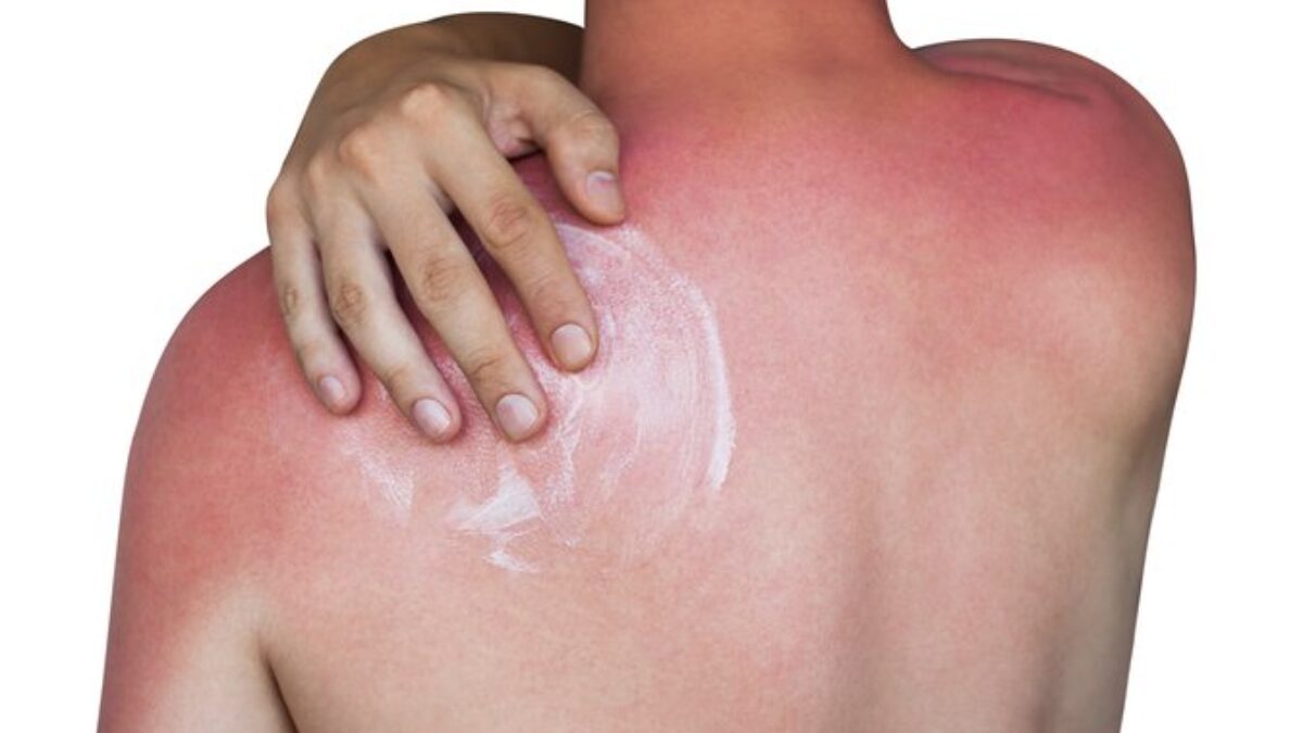 Čo pomáha na spálenie od slnka? Rady a tipy na prvú pomoc z prírody