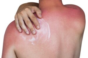 Čo pomáha na spálenie od slnka? Rady a tipy na prvú pomoc z prírody