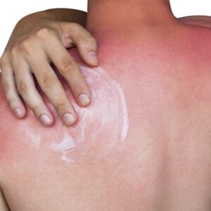 Čo pomáha na spálenie od slnka? Rady a tipy na prvú pomoc z prírody