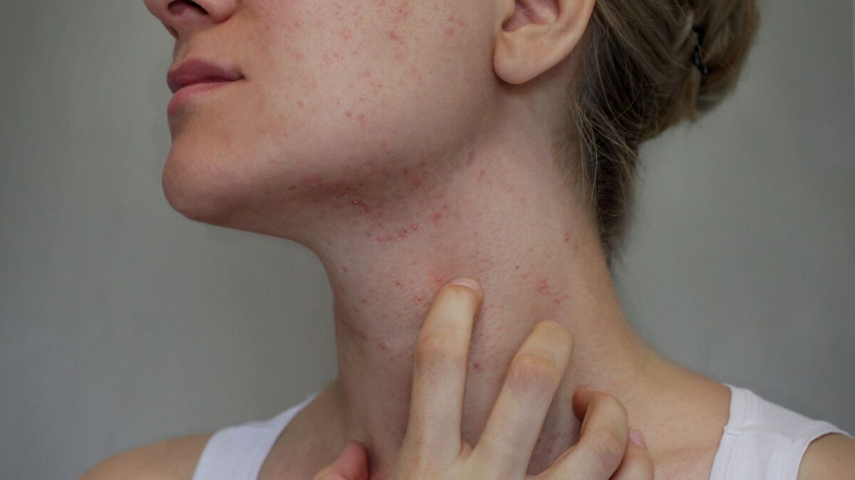 Jediný správny postup, ako sa zbaviť svrabu