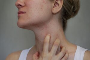 Jediný správny postup, ako sa zbaviť svrabu