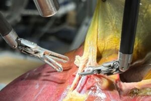 Je budúcnosť medicíny tu? Robot prvýkrát zvládol chirurgický zákrok s hovorenými...