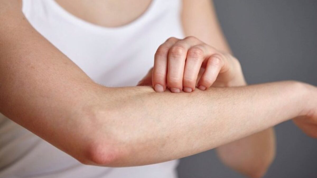 Neznesiteľné svrbenie a vyrážka. Svrabu sa darí celoročne a jeho výskyt neklesá,