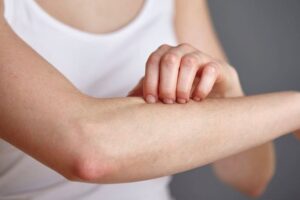 Neznesiteľné svrbenie a vyrážka. Svrabu sa darí celoročne a jeho výskyt neklesá,