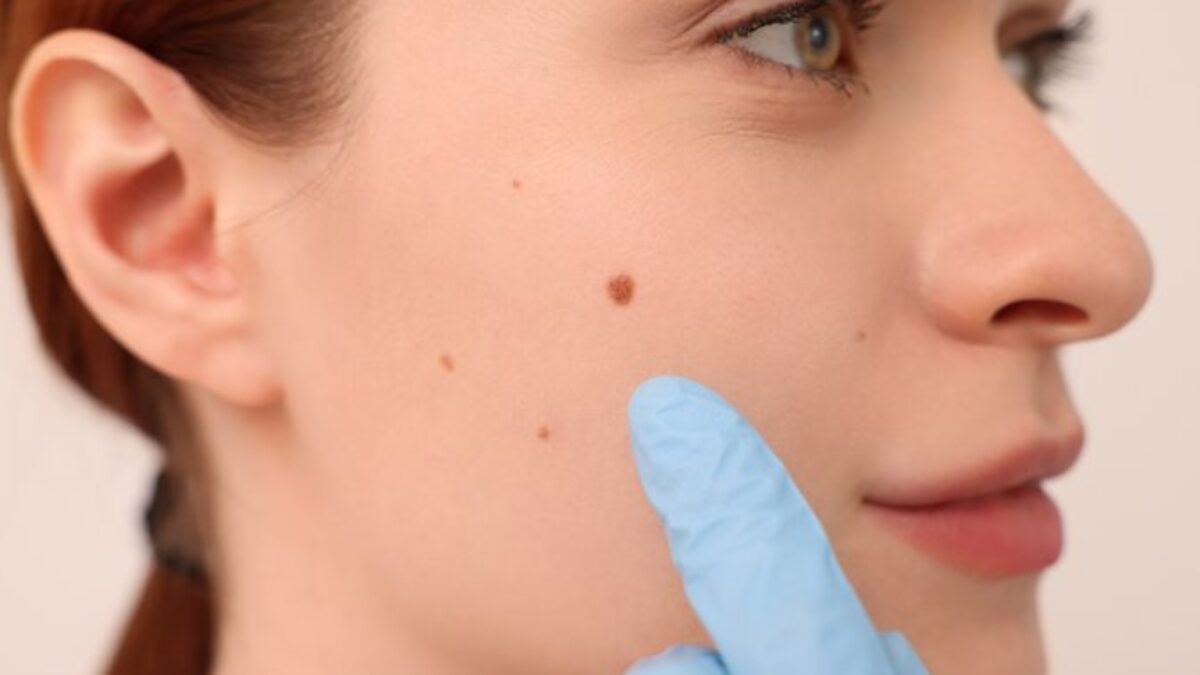 Pigmentové škvrny a pehy: Ako sa o ne starať v lete a ako sa ich zbaviť úplne
