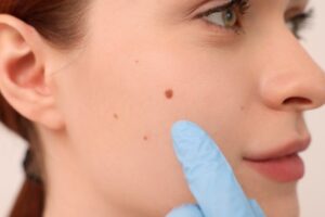 Pigmentové škvrny a pehy: Ako sa o ne starať v lete a ako sa ich zbaviť úplne