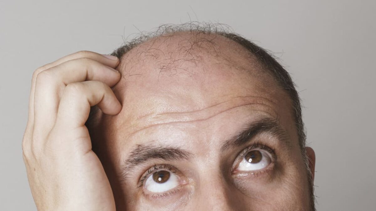 Nový liek na plešatenie? Experimenty na myšiach odhalili bežnú látku, ktorá môže zachrániť mnoho mužov