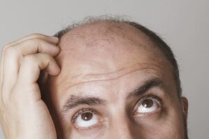 Nový liek na plešatenie? Experimenty na myšiach odhalili bežnú látku, ktorá môže...