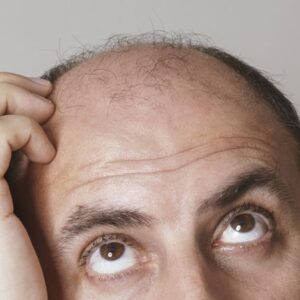 Nový liek na plešatenie? Experimenty na myšiach odhalili bežnú látku, ktorá môže...