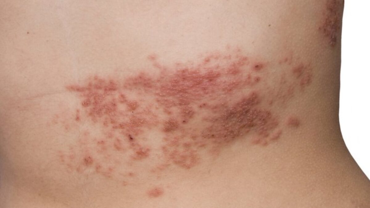 Pásový opar: Prečo a kedy zaútočí zo zálohy