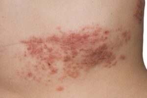 Pásový opar: Prečo a kedy zaútočí zo zálohy