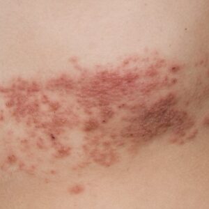 Pásový opar: Prečo a kedy zaútočí zo zálohy