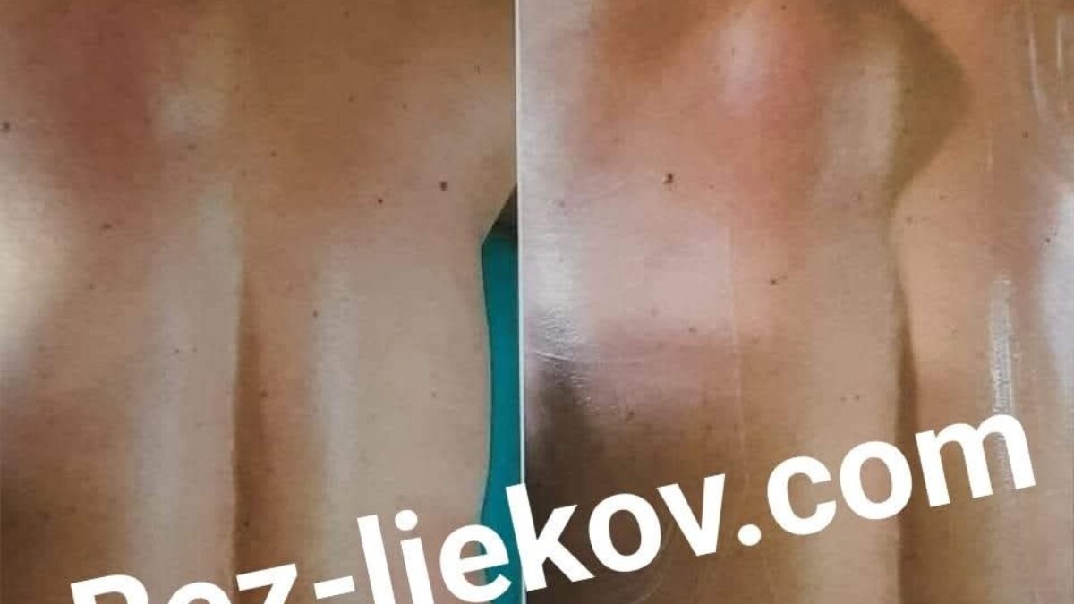 LIPÓMY – ako na podkožné tukové hrčky?