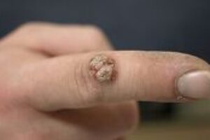 Mykóza nechtov a kožné výrastky