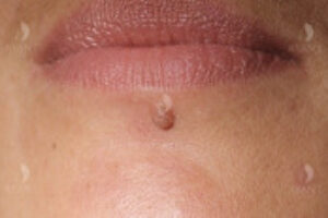 Odstránenie znamienok, bradavíc a ochlpenia, vymazanie HTML značiek z názvu, nep...