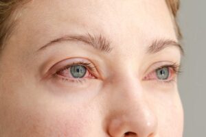 Nepohoda v oku: Ako riešiť najčastejšie očné problémy?