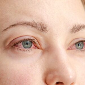 Nepohoda v oku: Ako riešiť najčastejšie očné problémy?