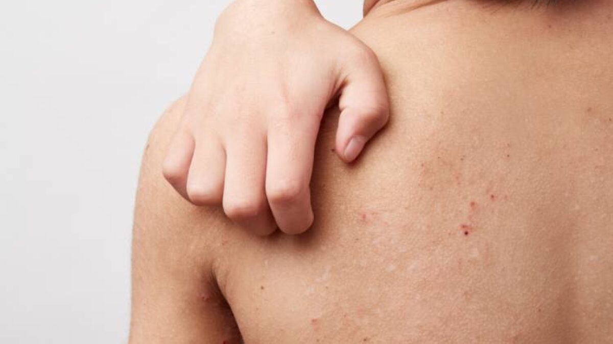 Potničky, ekzém, zapareniny? Objavte triky, ako si s nimi poradiť!