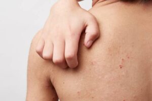 Potničky, ekzém, zapareniny? Objavte triky, ako si s nimi poradiť!