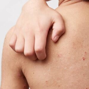 Potničky, ekzém, zapareniny? Objavte triky, ako si s nimi poradiť!