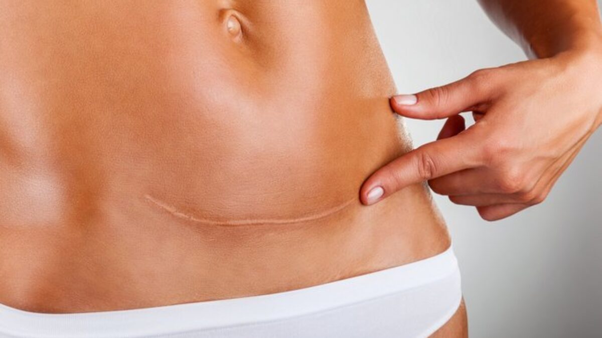 Ako sa starať o jazvu, aby bola čo najmenej vidieť. Mažte ju masťou a masírujte Ako sa starať o jazvu, aby bola čo najmenej vidieť. Mažte ju masťou a masírujte