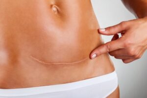 Ako sa starať o jazvu, aby bola čo najmenej vidieť. Mažte ju masťou a masírujte