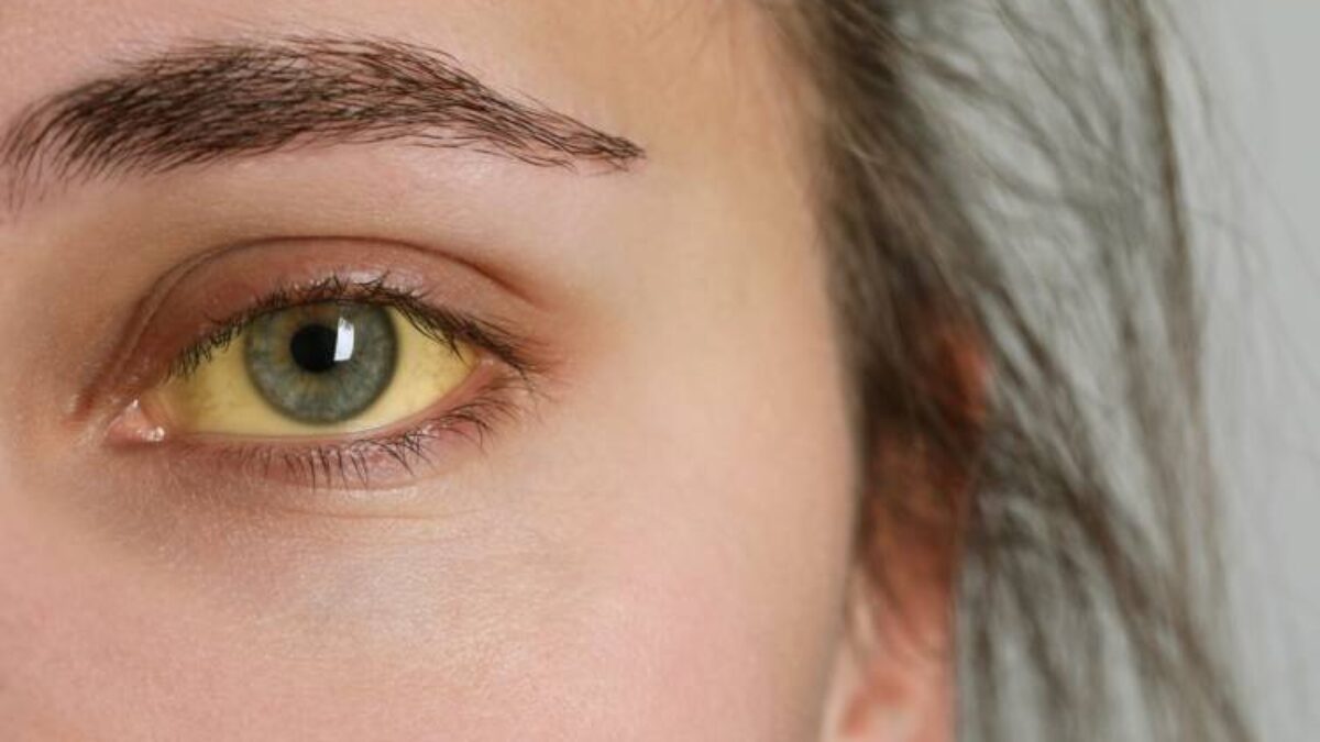 Žltačka na vzostupe: Choroba špinavých rúk ohrozuje hlavne mladých