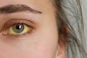 Žltačka na vzostupe: Choroba špinavých rúk ohrozuje hlavne mladých