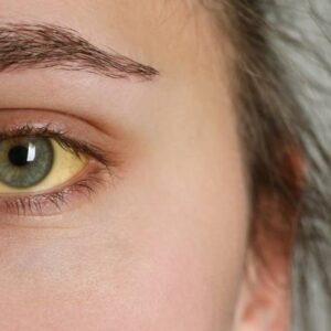 Žltačka na vzostupe: Choroba špinavých rúk ohrozuje hlavne mladých