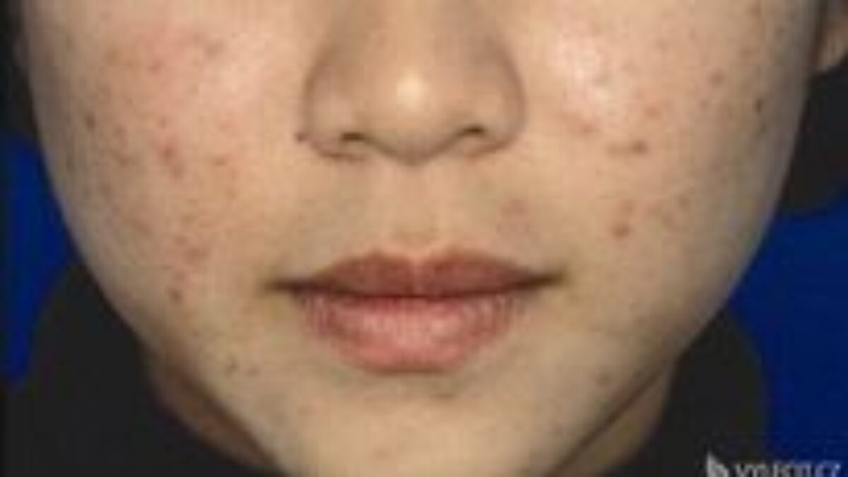 Ako predísť akné správnou starostlivosťou o pleť?