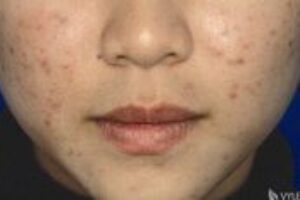 Ako predísť akné správnou starostlivosťou o pleť?