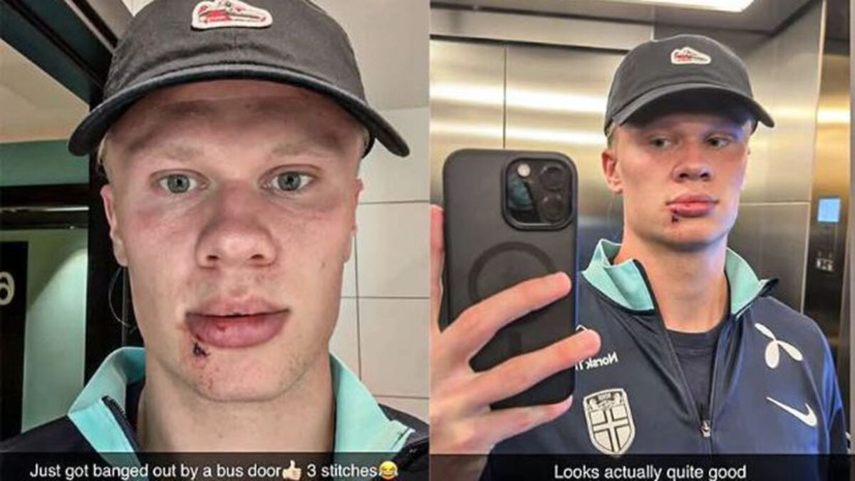 Haaland a bizarné zranenie: Nórsky útočník sa pochválil stehmi