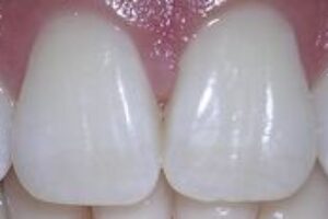 Zuby ako perličky alebo ako (ne)bieliť?