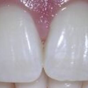 Zuby ako perličky alebo ako (ne)bieliť?