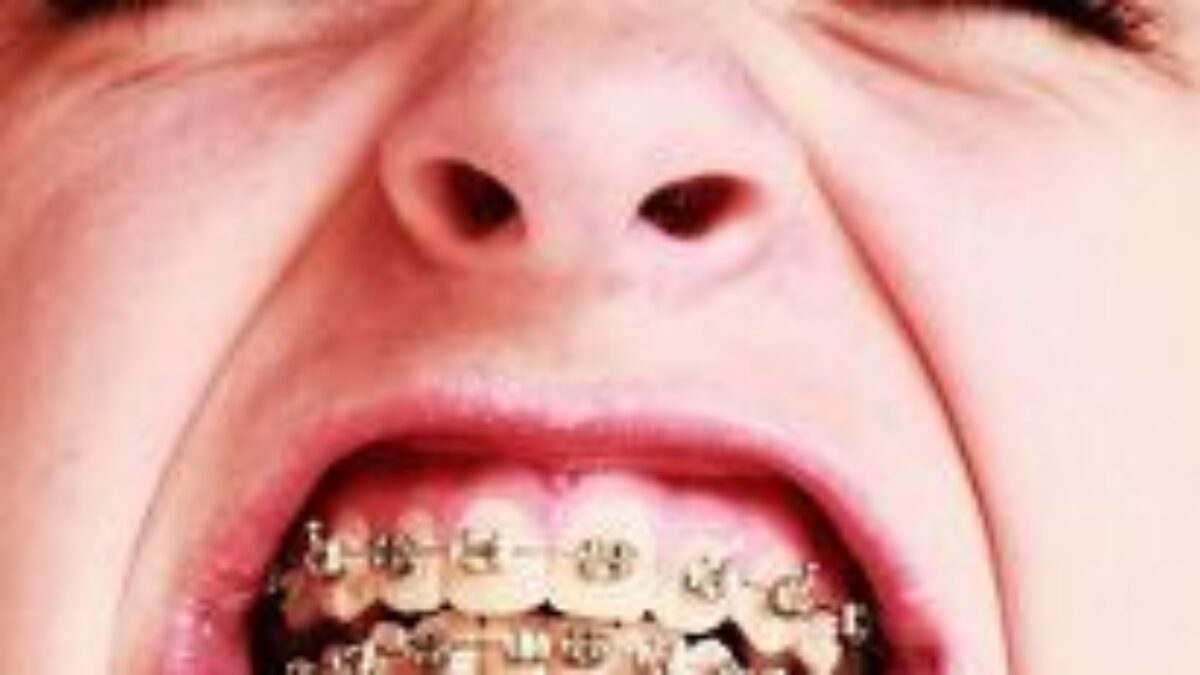 Obrusovanie zubov je defekt, ktorým možno trpíte aj vy Obrusovanie zubov je defekt, ktorým možno trpíte aj vy