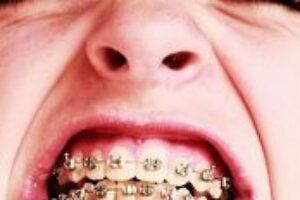 Obrusovanie zubov je defekt, ktorým možno trpíte aj vy