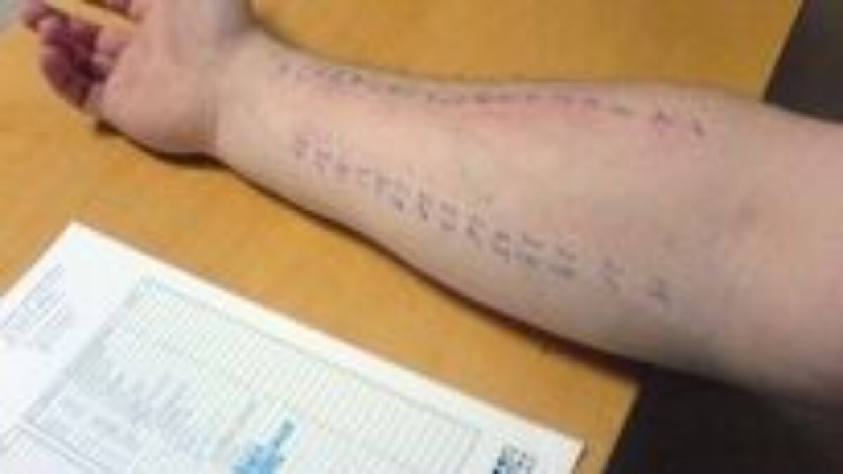 Ako rýchlo a účinne bojovať s alergickou reakciou?