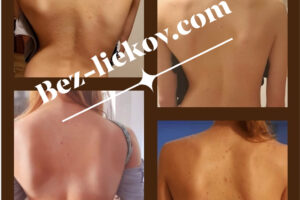 #SKOLIÓZA – KRÁSNE VÝSLEDKY